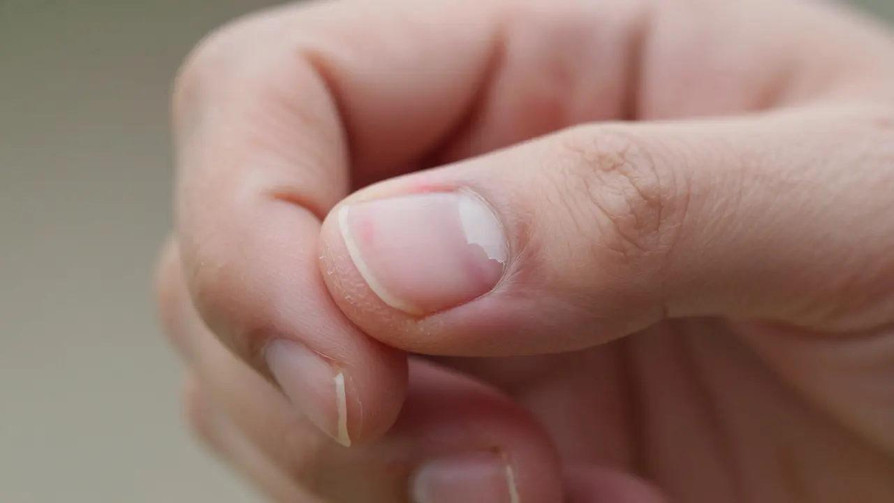 Jak obnovit nehtové lůžko po poškození nebo nehtové infekci