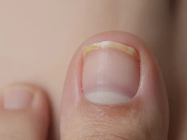 Jak vypadá plíseň na nehtech u nohou? Příznaky a jak je poznat